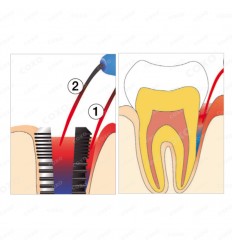 LED-hærdelampe med lys -aktiveret desinfektion