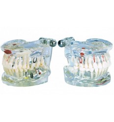 Patologisk model med implantat