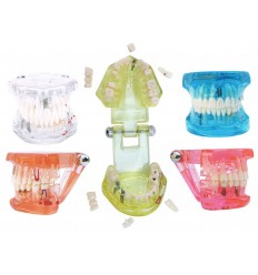 Model med krone, bro og implantat