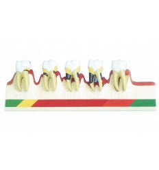 Periodontitis-udviklings-model 